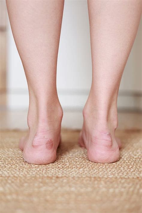 Feet Blisters White At Mae Burley Blog