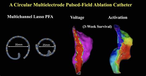 Pulsed Field Ablation In Ventricular Myocardium Using A Off