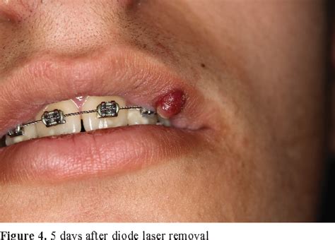 Figure 4 From Posthaste Outgrow Of Lip Pyogenic Granuloma After Diode