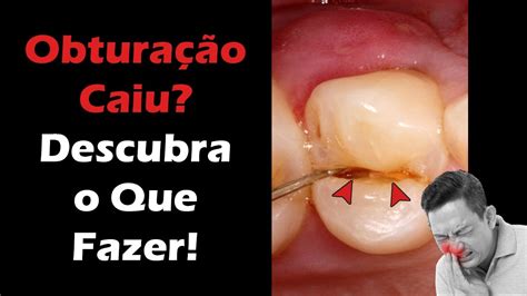 Obturação Caiu Descubra O Que Fazer E Como Aliviar A Dor De Um Dente