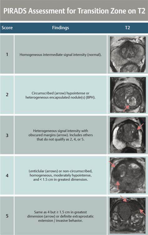 Prostate Imaging Reporting And Data System Pi Rads Radiology Hot Sex