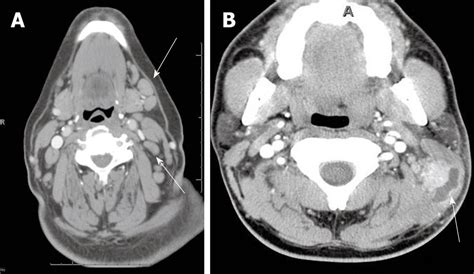 Computed Tomography Imaging Of Acute Neck Inflammatory Processes