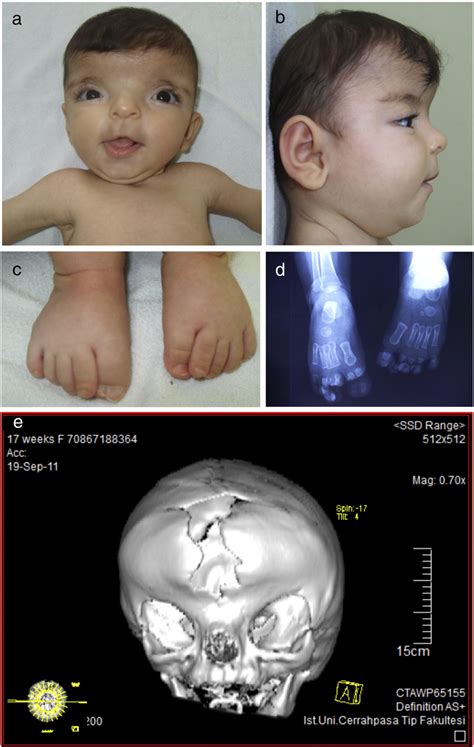 Figure From A Novel Efnb Mutation In A Patient With