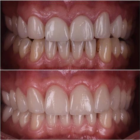 Intra Oral Photos Of Previous Case Crown Lengthening Was Performed