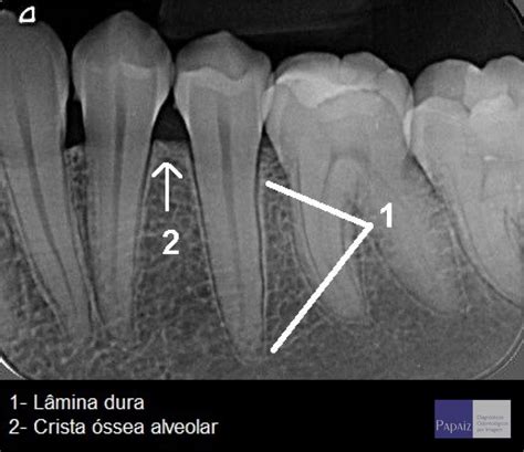 NOVEMBRO 2020 Radiologia Odontológica Aplicada à Periodontia LII