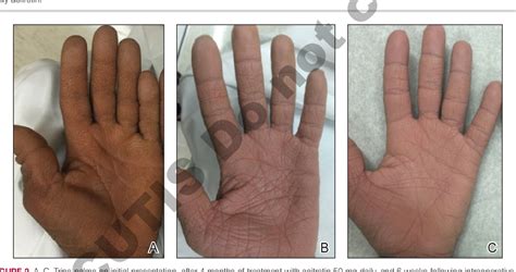 Figure From Paraneoplastic Signs In Bladder Transitional Cell