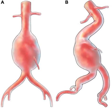 Illustrations For Abdominal Aortic Aneurysm With Hostile Anatomy A Download Scientific