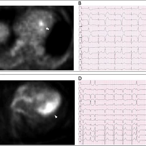 Pet Ct And Pvc Correlation Matched Findings In A And B With A Pet Ct