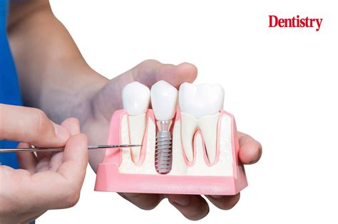 Understanding Peri Implantitis An Interview With Nikos Donos Dentistry