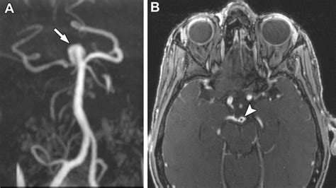 Cerebral Aneurysm Mri