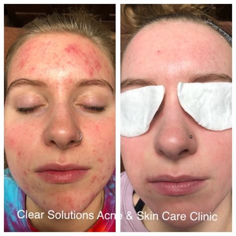 Before & Afters - Clear Solutions Acne & Skin Care Clinic