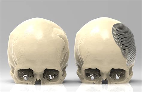 Digital Evolution Of Cranial Surgery