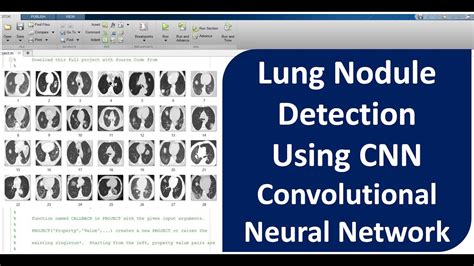 Lung Nodule Detection Using Cnn Convolutional Neural Network Lung