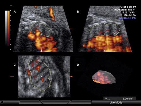 Quantitative Analysis Of Fetal Pulmonary Vasculature By 3 Dimensional