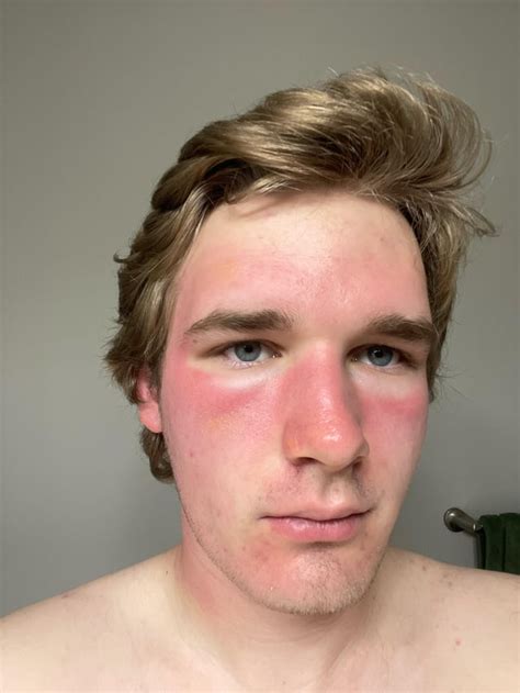 Is This 1st Or 2nd Degree Sunburn Rmedicaladvice