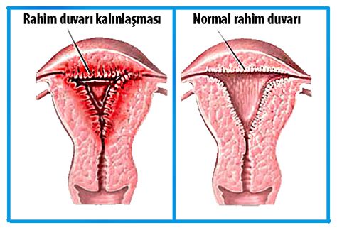 Rahim Duvarı Kalınlaşması Nedir Neden Olur Op Dr Gönül Çimen