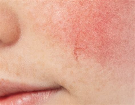 Rosacea Treatment Dermatica