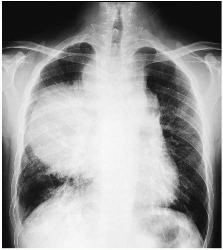 Nonseminomatous Germ Cell Tumor Thoracic Key