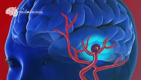 Aneurisma Cerebral Saiba As Causas E Tratamentos Otosection