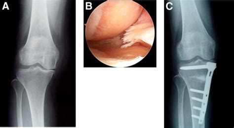 Medial Opening Wedge High Tibial Osteotomy With Early Full Weight