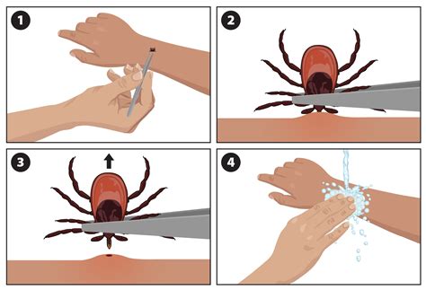 What to Do After a Tick Bite | Ticks | CDC