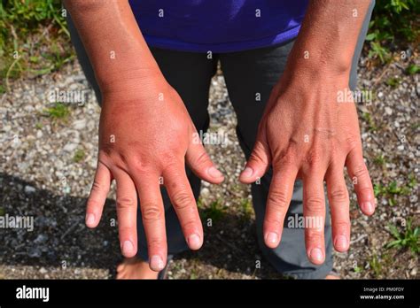Red Wasp Sting Swelling