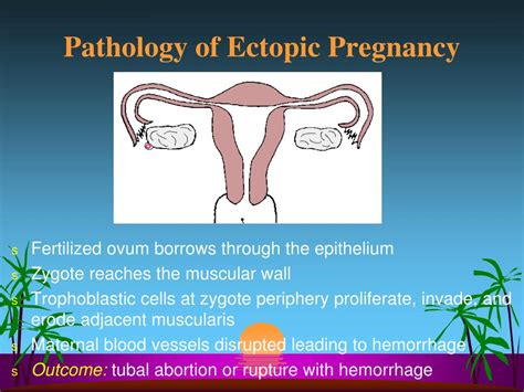 Ppt Ectopic Pregnancy Powerpoint Presentation Free Download Id 6611966