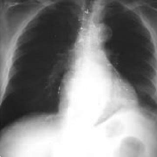 Chest Radiograph PA View 2 Weeks After Treatment With Steroids