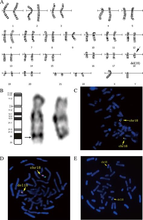 Identification Of Chromosome 18 Terminal Deletion A Gtg Banded Download Scientific Diagram