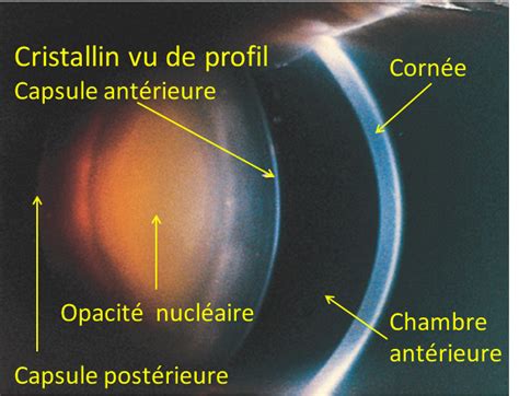 cataracte Dr Michael VARSORI Spécialiste FMH en Ophtalmologie et