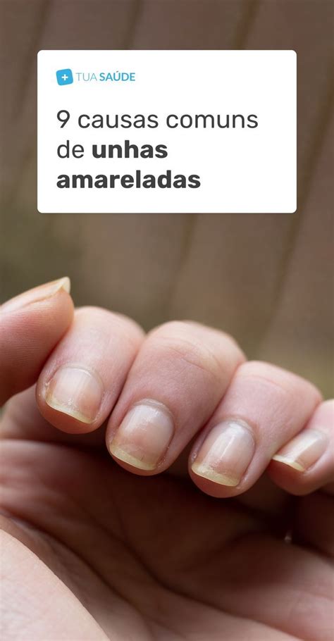 O Que Pode Ser Unhas Amareladas E O Que Fazer Unhas E Sa De Unhas