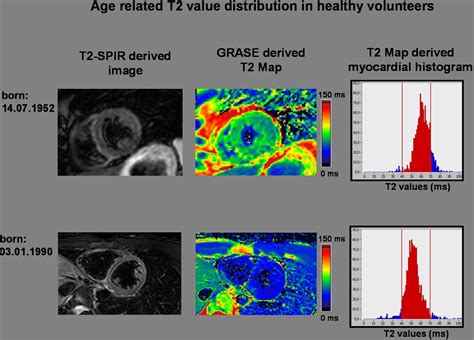 T Mapping In Different Cardiomyopathies First Clinical Experience