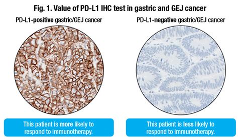 Scoring Gastric Gej Cancers For Pd L Expression Cap Today