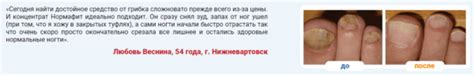 Нормафит от грибка – отзывы, цена, инструкция