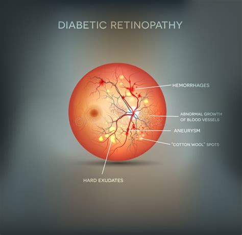 Diabetic Retinopathy Stock Vector Illustration Of Hair 20016314