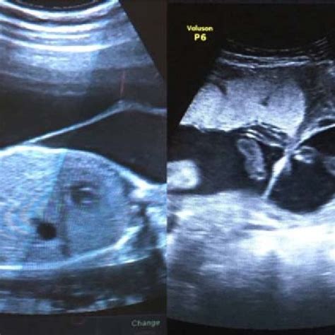 A The First Image Is Amniotic Band And 1b Second Image Is