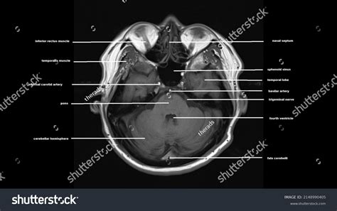 Normal Brain Anatomy Axial T1weighted Mri Stock Photo 2148990405