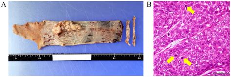 Resected Specimen Of Esophageal Cancer A Gross Appearance Of The