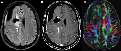 Perfusion Weighted Imaging Pwi Brain Mri Of A Old With A Diagnosis