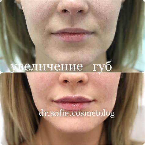 Увеличение губ | Lips, Instagram, Capture