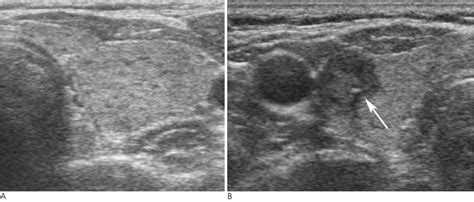 Hashimoto's Ultrasound