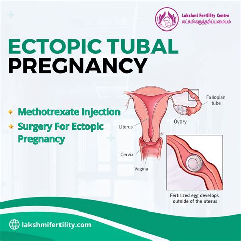 ECTOPIC TUBAL PREGNANCY