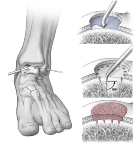 Osteochondral Lesion Talus