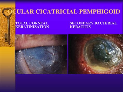 Ppt Episcleritis Scleritis Powerpoint Presentation Free Download