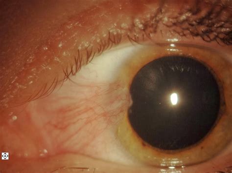 PTERYGIUM | Sonoran Desert Eye Center