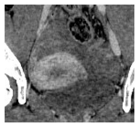 Dynamic Contrast Enhancement Ct Scan After Injection Of Contrast