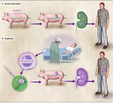 全球首例基因编辑猪心脏移植到患者体内：异种移植 近在咫尺？ 老虎社区 美港股上老虎 老虎社区