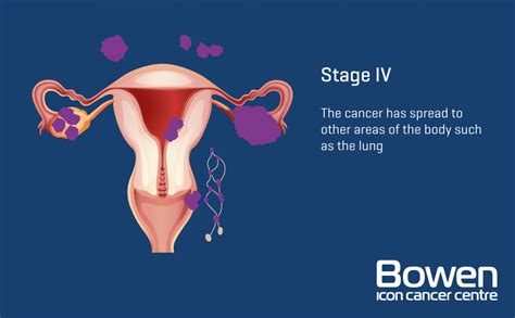 What Is Ovarian Cancer Ovarian Cancer Explained — Bowen Icon Cancer Centre