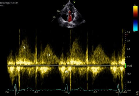 Pulmonary Venous Flow Using PW Doppler Echocardiography S Systolic