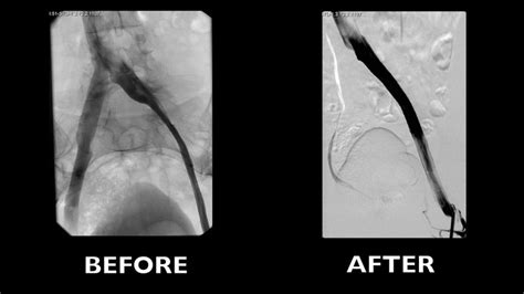 Video Post Thrombotic Syndrome With High Grade Compression Stenosis